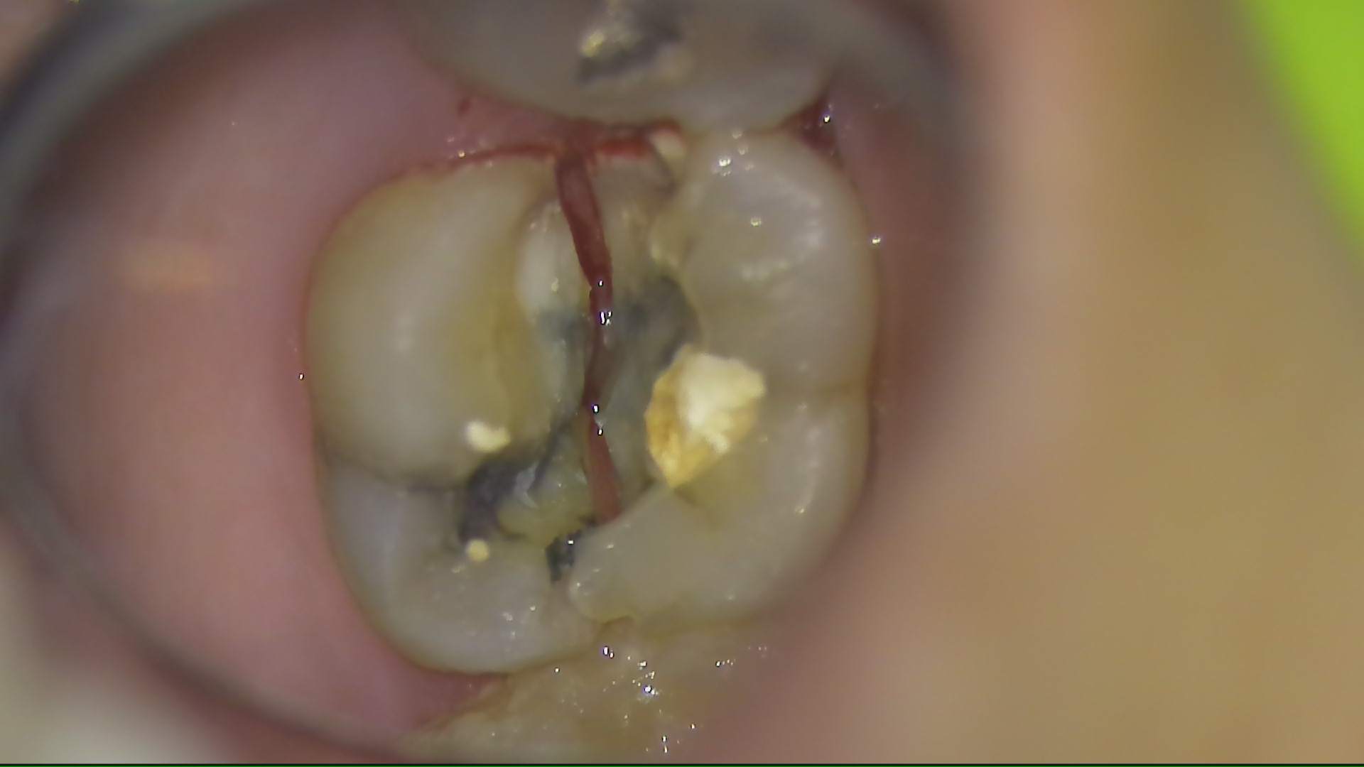 歯 が 割れ た 治療