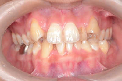 歯並びのお話 その 八重歯 名古屋市千種区 たなか歯科クリニック