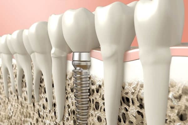 第二の永久歯と呼ばれる、インプラント